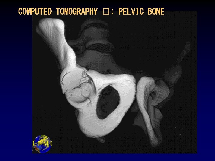 COMPUTED TOMOGRAPHY �: PELVIC BONE 