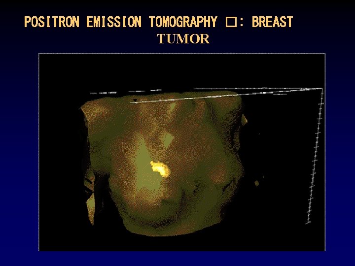 POSITRON EMISSION TOMOGRAPHY �: BREAST TUMOR 