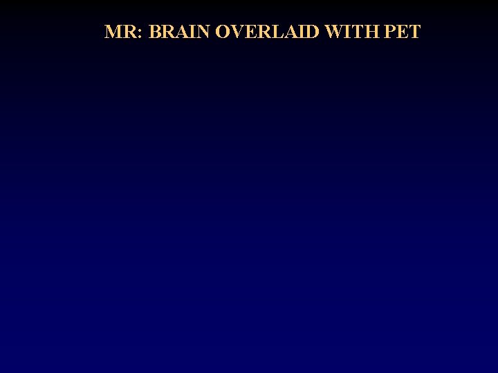 MR: BRAIN OVERLAID WITH PET 