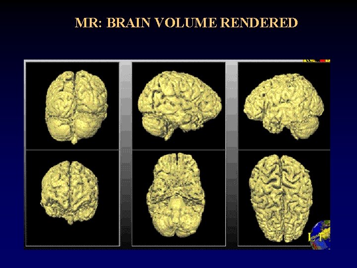 MR: BRAIN VOLUME RENDERED MR: BRAIN VOLUME RENDERED