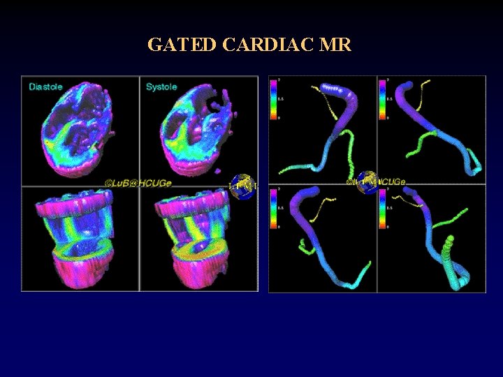 GATED CARDIAC MR 