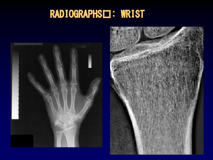 RADIOGRAPHS�: WRIST 