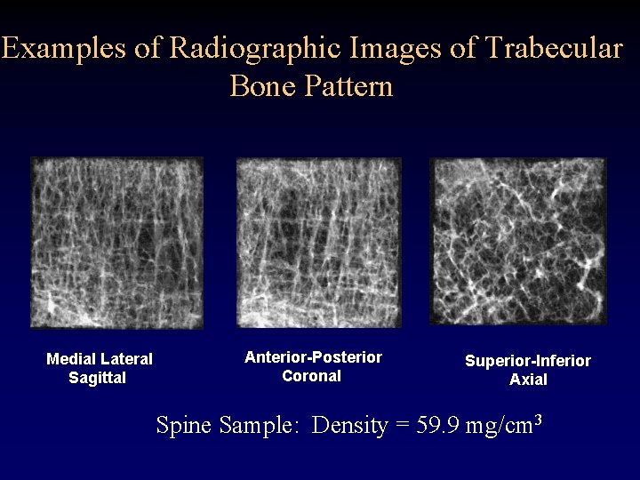 Examples of Radiographic Images of Trabecular Bone Pattern Medial Lateral Sagittal Anterior-Posterior Coronal Superior-Inferior