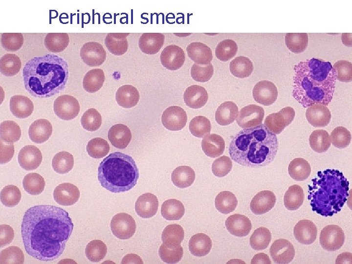 Peripheral smear 