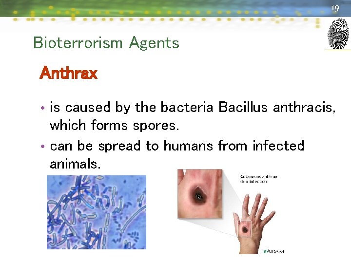19 Bioterrorism Agents Anthrax • is caused by the bacteria Bacillus anthracis, which forms
