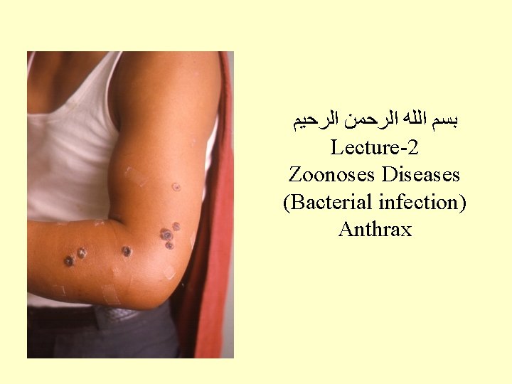  ﺑﺴﻢ ﺍﻟﻠﻪ ﺍﻟﺮﺣﻤﻦ ﺍﻟﺮﺣﻴﻢ Lecture-2 Zoonoses Diseases (Bacterial infection) Anthrax 
