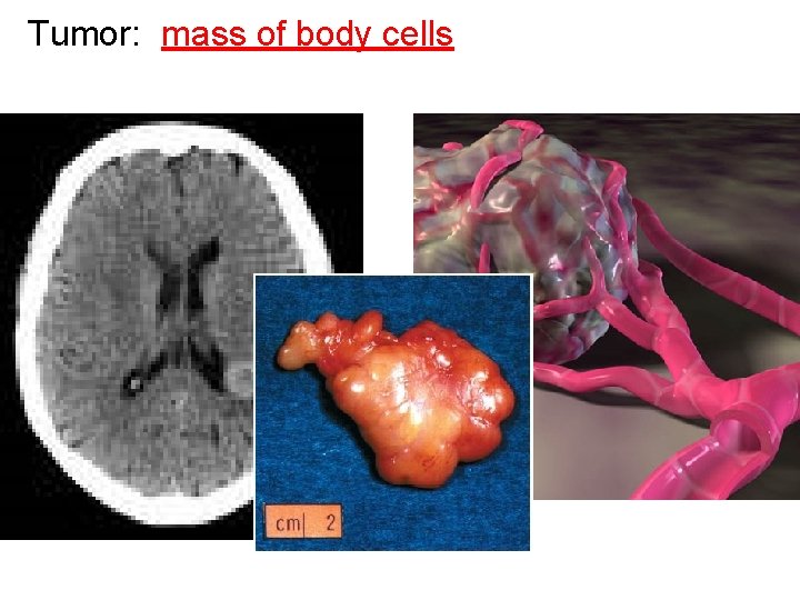Tumor: mass of body cells 