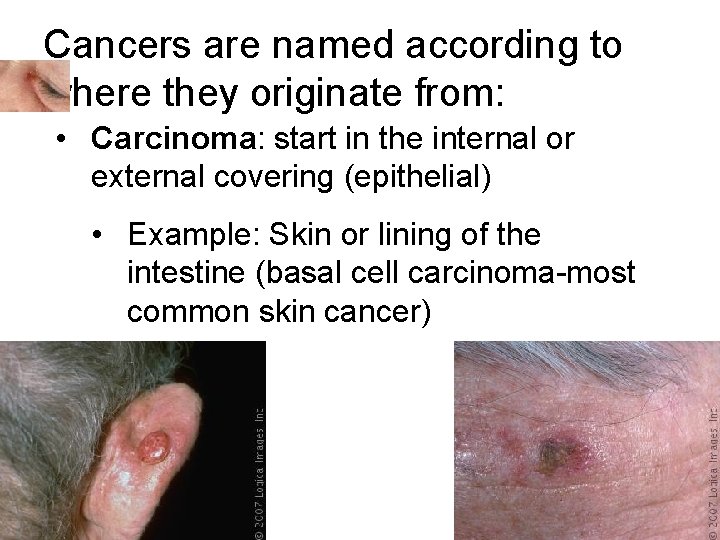 Cancers are named according to where they originate from: • Carcinoma: start in the