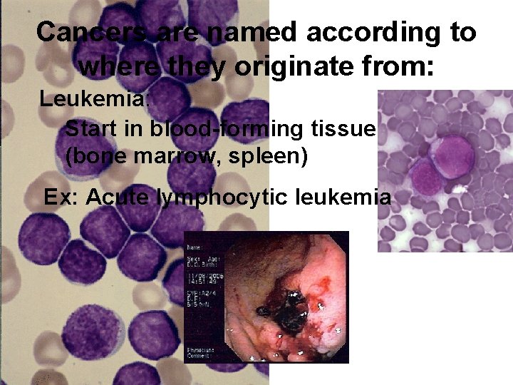 Cancers are named according to where they originate from: Leukemia: Start in blood-forming tissue