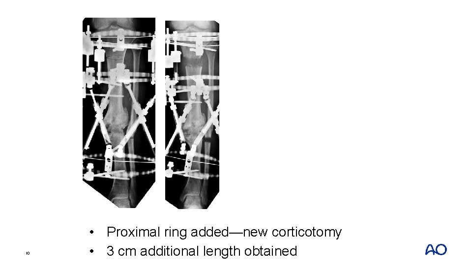 10 • Proximal ring added—new corticotomy • 3 cm additional length obtained 