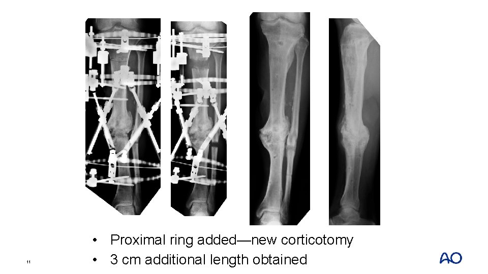 11 • Proximal ring added—new corticotomy • 3 cm additional length obtained 