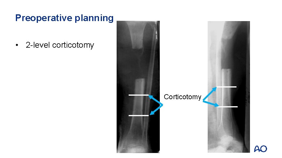 Preoperative planning • 2 -level corticotomy Corticotomy 