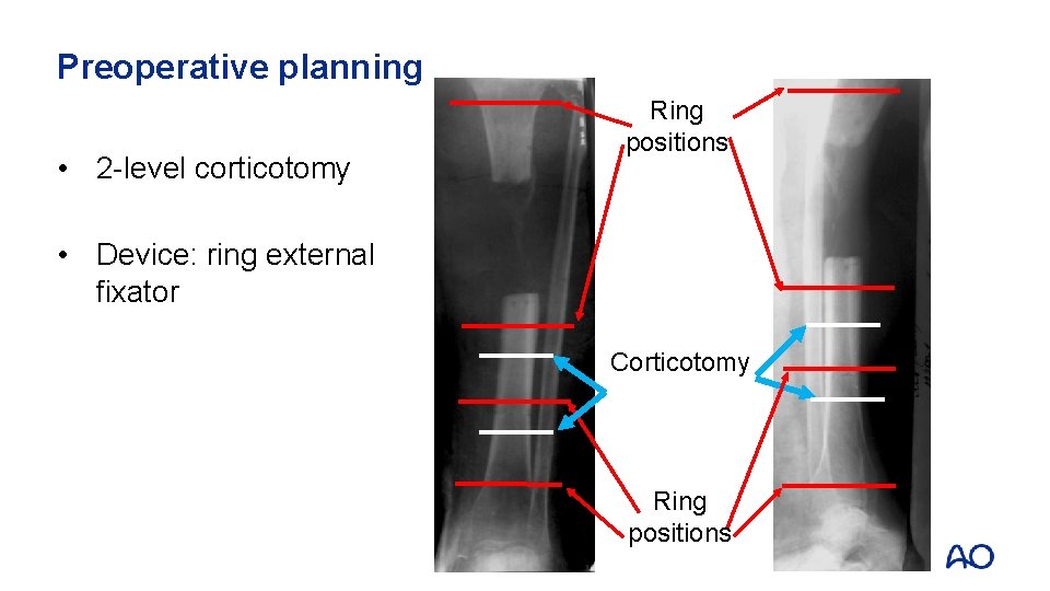 Preoperative planning • 2 -level corticotomy Ring positions • Device: ring external fixator Corticotomy