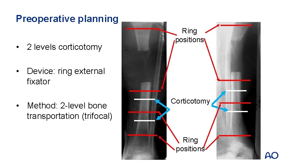 Preoperative planning • 2 levels corticotomy Ring positions • Device: ring external fixator •