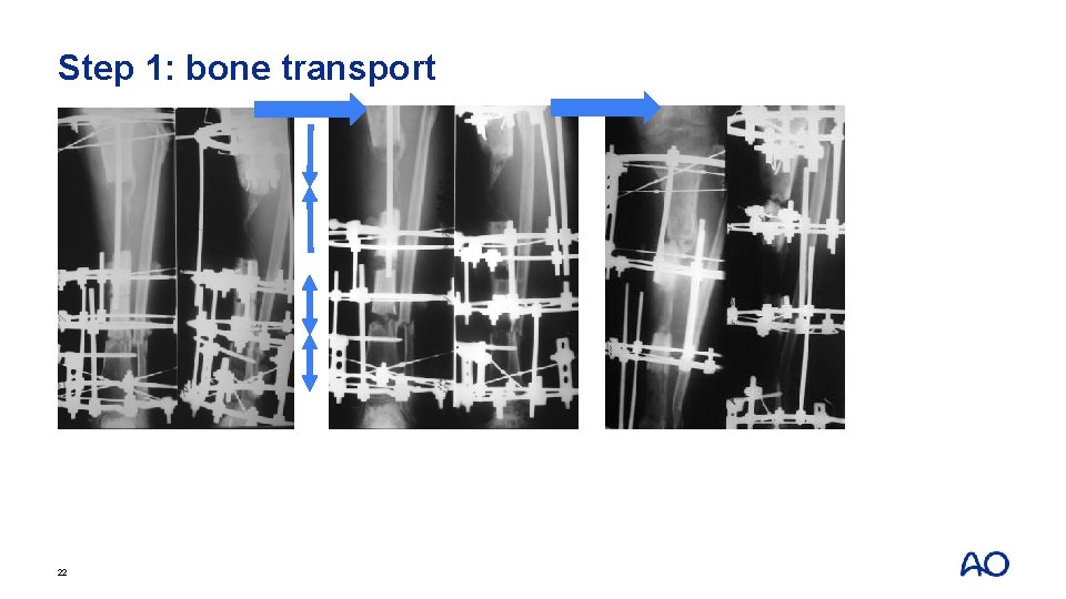 Step 1: bone transport 22 