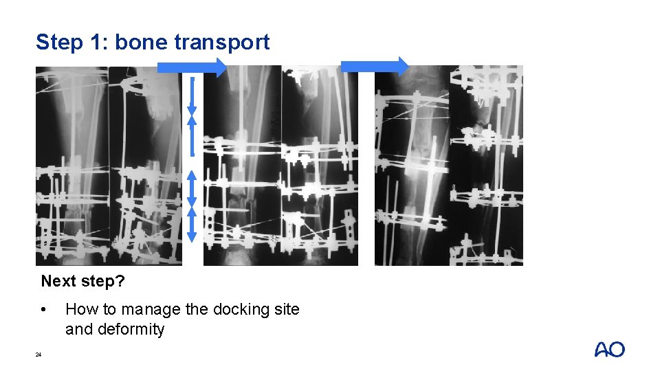 Step 1: bone transport Next step? • 24 How to manage the docking site