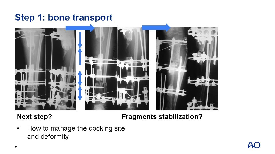 Step 1: bone transport Next step? • 25 Fragments stabilization? How to manage the