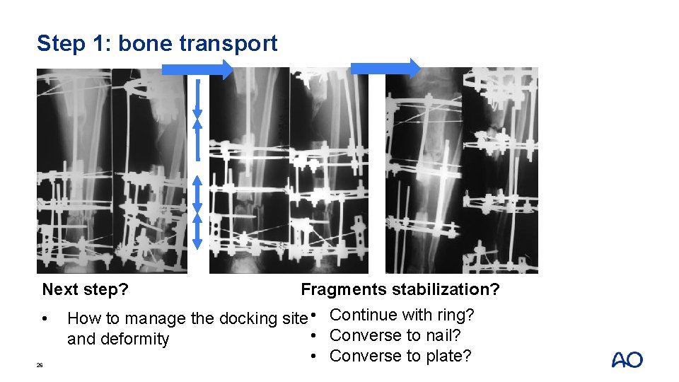 Step 1: bone transport Next step? • 26 Fragments stabilization? How to manage the