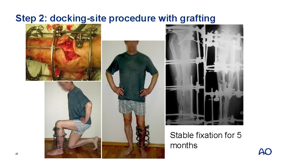 Step 2: docking-site procedure with grafting Stable fixation for 5 months 27 