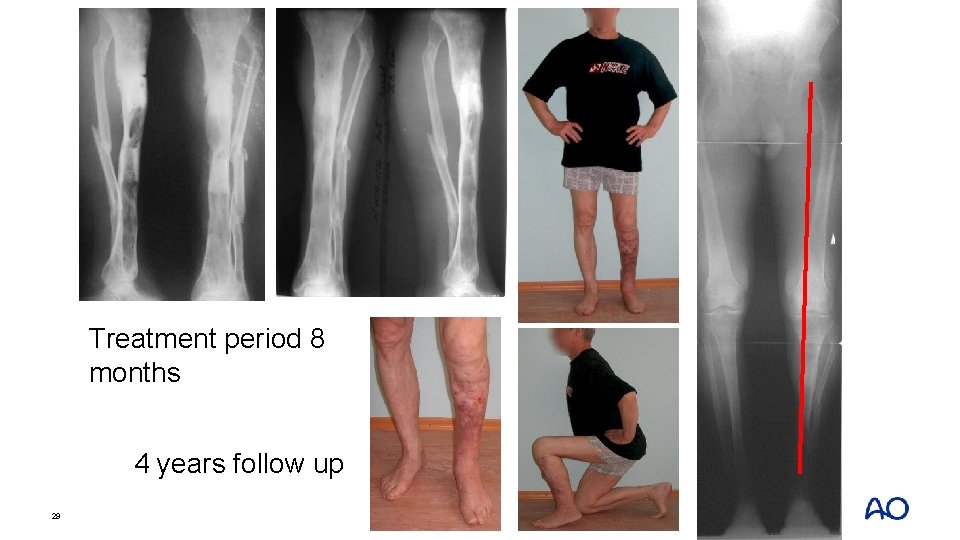 Treatment period 8 months 4 years follow up 29 