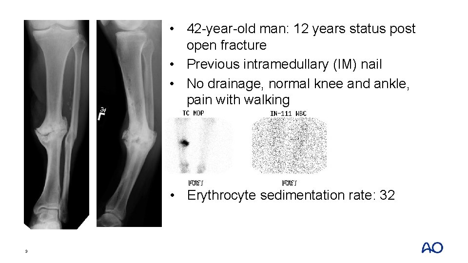  • 42 -year-old man: 12 years status post open fracture • Previous intramedullary