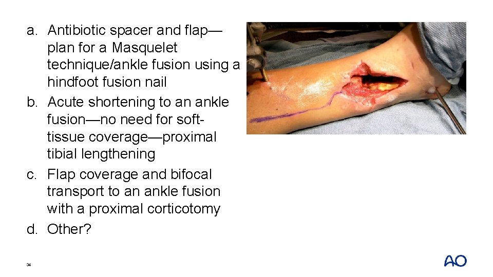 a. Antibiotic spacer and flap— plan for a Masquelet technique/ankle fusion using a hindfoot