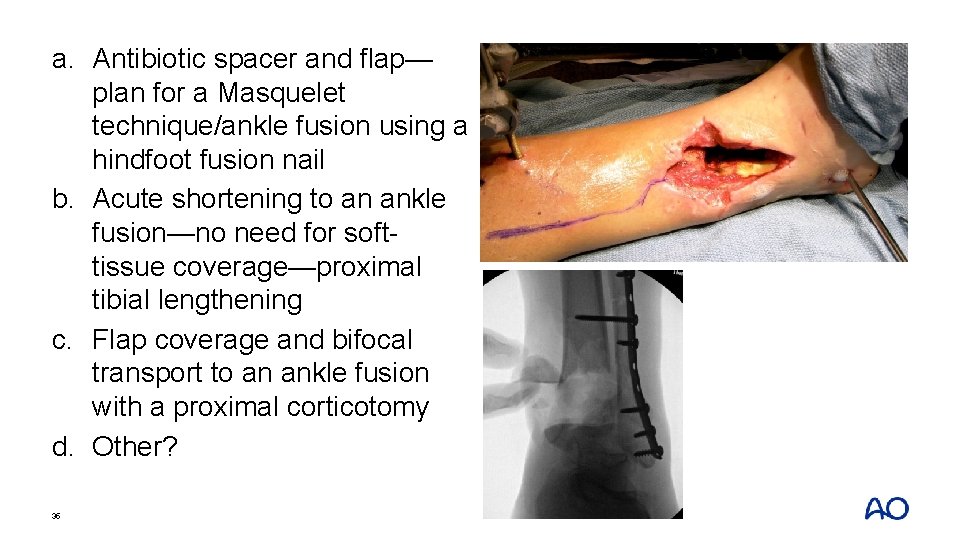 a. Antibiotic spacer and flap— plan for a Masquelet technique/ankle fusion using a hindfoot