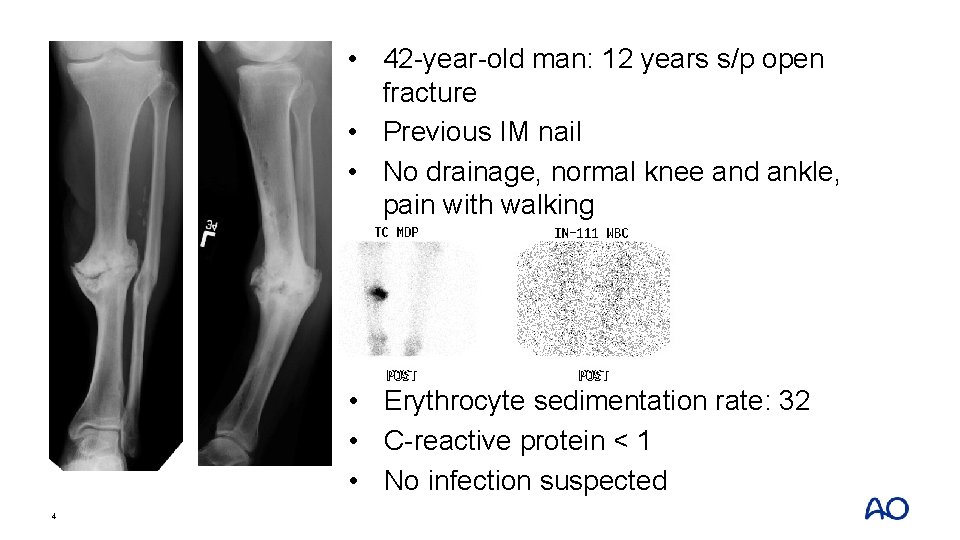  • 42 -year-old man: 12 years s/p open fracture • Previous IM nail