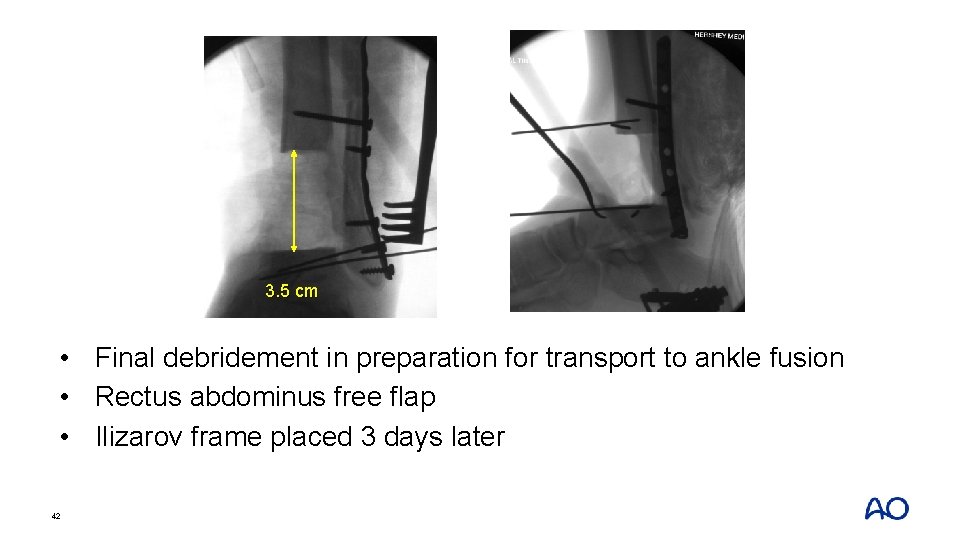 3. 5 cm • Final debridement in preparation for transport to ankle fusion •