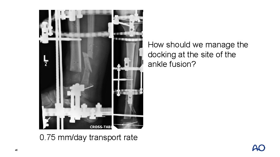 How should we manage the docking at the site of the ankle fusion? 0.