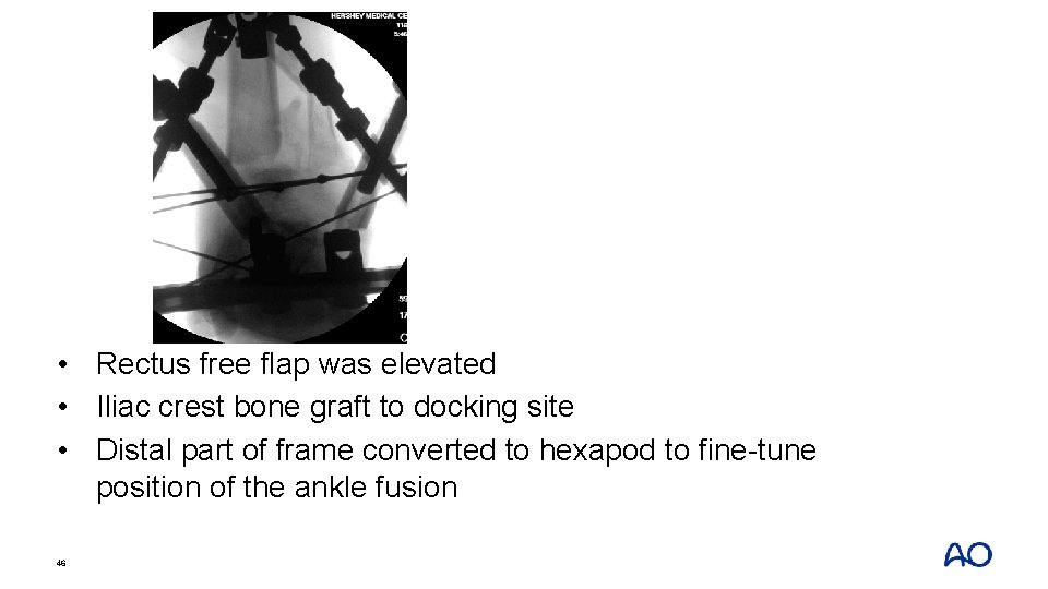  • Rectus free flap was elevated • Iliac crest bone graft to docking