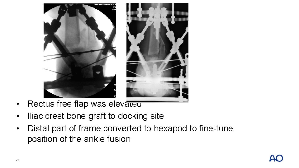 • Rectus free flap was elevated • Iliac crest bone graft to docking