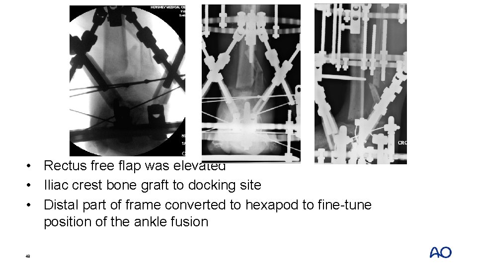  • Rectus free flap was elevated • Iliac crest bone graft to docking