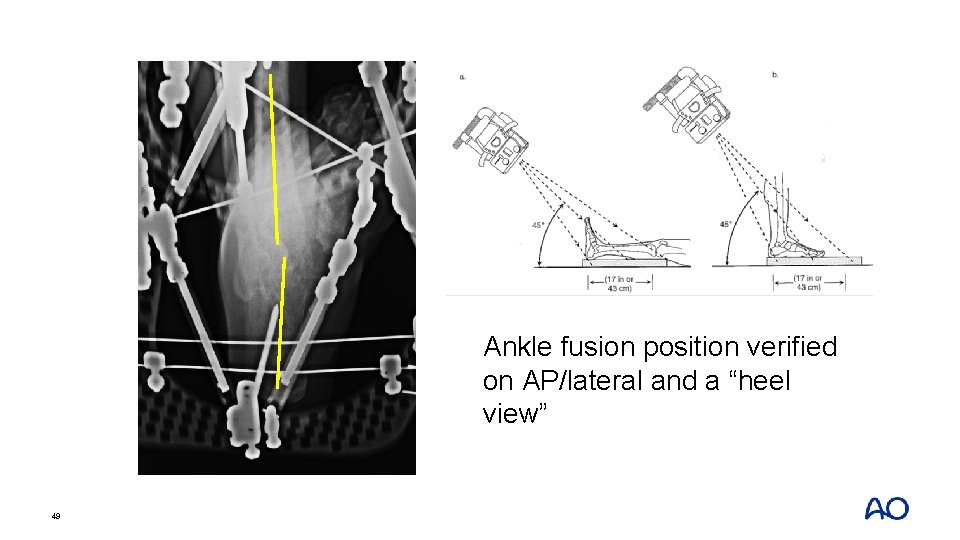 Ankle fusion position verified on AP/lateral and a “heel view” 49 