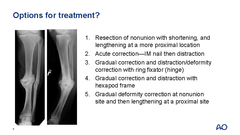 Options for treatment? 1. Resection of nonunion with shortening, and lengthening at a more