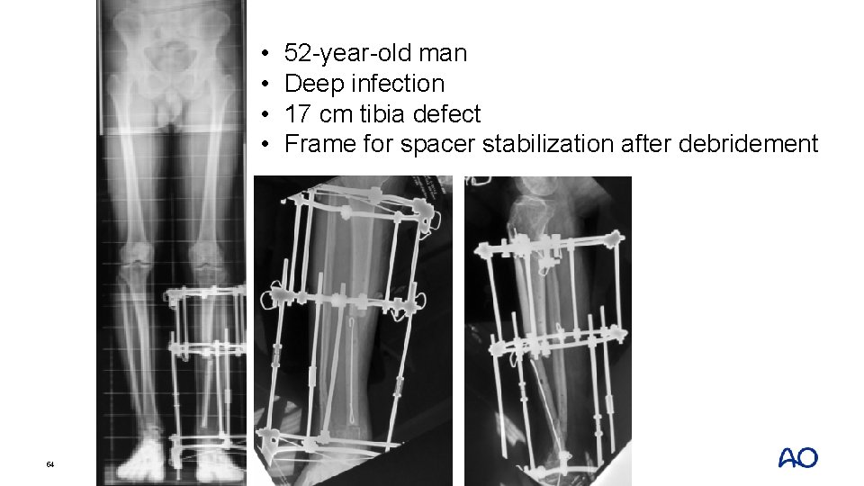  • • 54 52 -year-old man Deep infection 17 cm tibia defect Frame