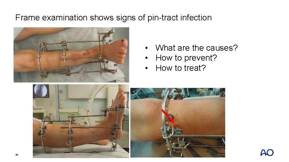 Frame examination shows signs of pin-tract infection • What are the causes? • How