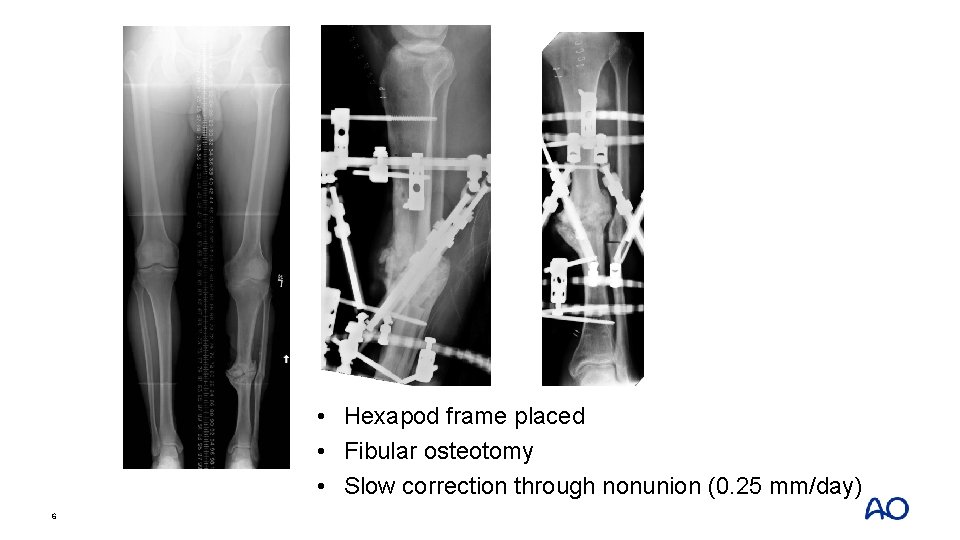  • Hexapod frame placed • Fibular osteotomy • Slow correction through nonunion (0.
