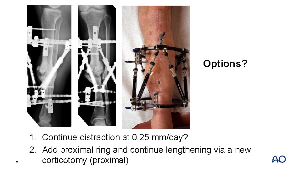 Options? 8 1. Continue distraction at 0. 25 mm/day? 2. Add proximal ring and