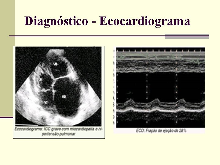 Diagnóstico - Ecocardiograma 