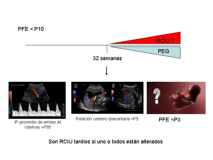 PFE < P 10 RCIU T PEG 32 semanas IP promedio de ambas At