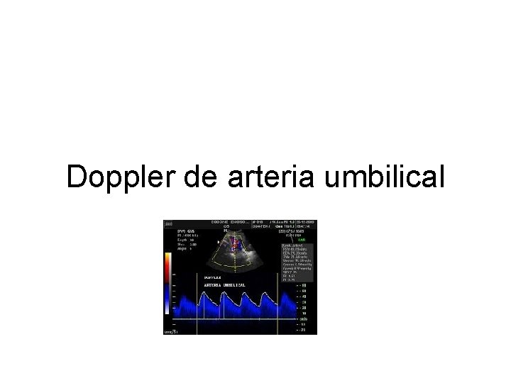 Doppler de arteria umbilical 