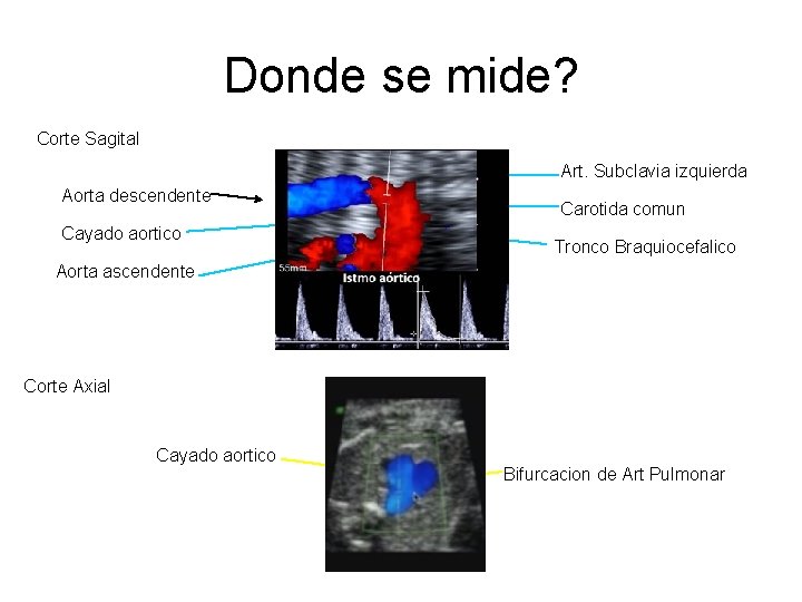 Donde se mide? Corte Sagital Art. Subclavia izquierda Aorta descendente Cayado aortico Carotida comun