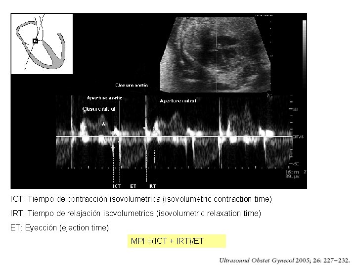 ICT: Tiempo de contracción isovolumetrica (isovolumetric contraction time) IRT: Tiempo de relajación isovolumetrica (isovolumetric