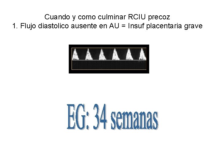 Cuando y como culminar RCIU precoz 1. Flujo diastolico ausente en AU = Insuf