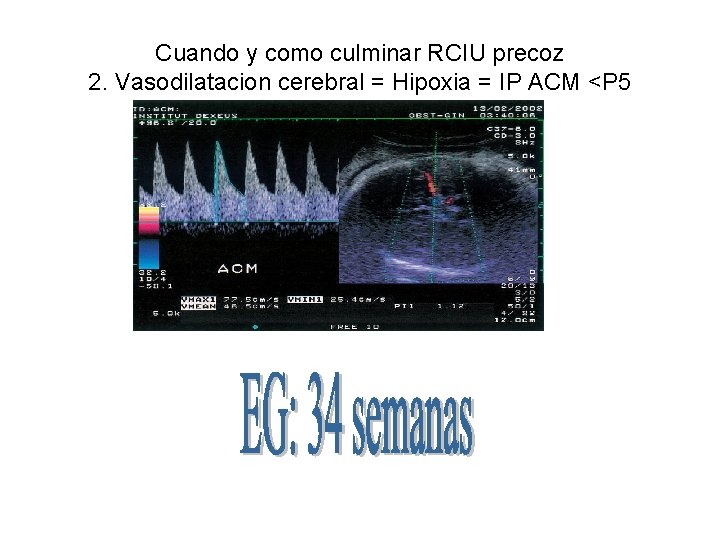 Cuando y como culminar RCIU precoz 2. Vasodilatacion cerebral = Hipoxia = IP ACM