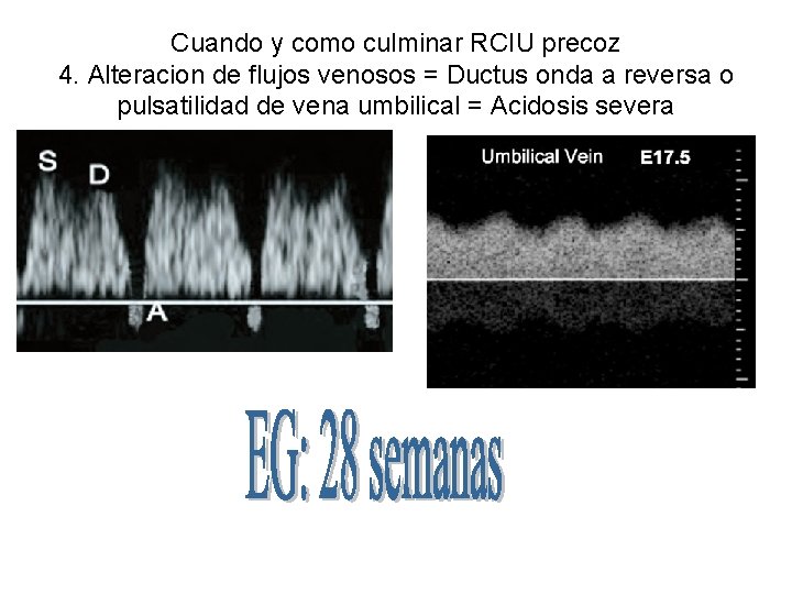 Cuando y como culminar RCIU precoz 4. Alteracion de flujos venosos = Ductus onda