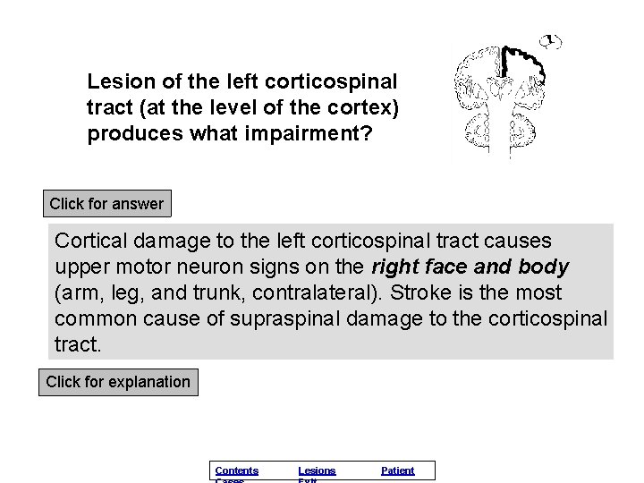 Lesion of the left corticospinal tract (at the level of the cortex) produces what