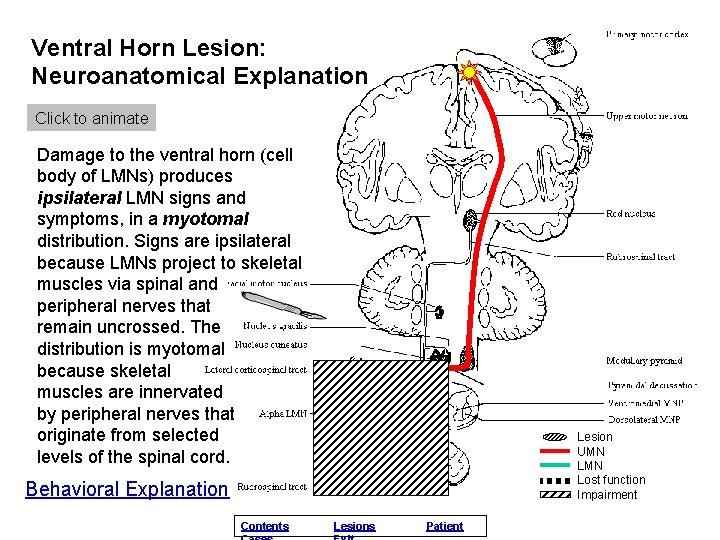 Ventral Horn Lesion: Neuroanatomical Explanation Click to animate Damage to the ventral horn (cell