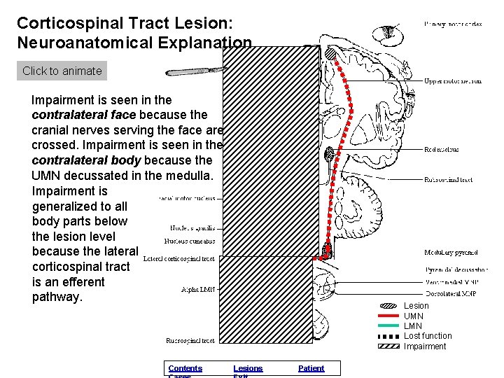 Corticospinal Tract Lesion: Neuroanatomical Explanation Click to animate Impairment is seen in the contralateral